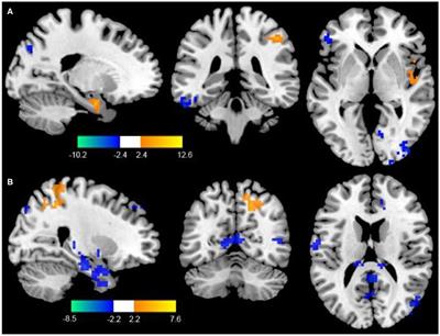 Cerebral Functional Manipulation of Repetitive Transcranial Magnetic Stimulation in Cognitive Impairment Patients After Stroke: An fMRI Study